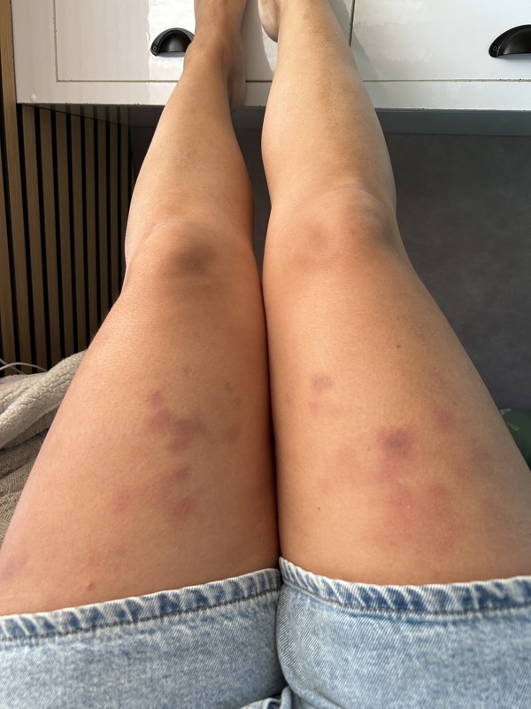 Résultat d’une seule journée de travail dans la récolte de cerise.. heureusement pour mes jambes qu’on n’a pas fait plus d’1 jour et demi